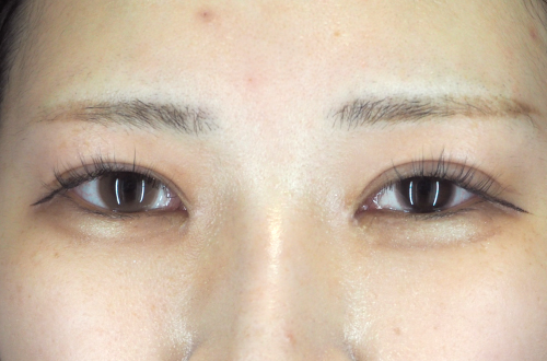 目頭切開法（20代｜女性）3ヶ月後