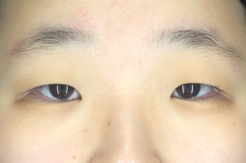 眼瞼下垂（10代｜女性）