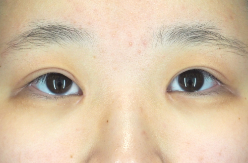 眼瞼下垂（10代｜女性）3ヶ月後