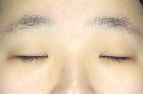 眼瞼下垂（10代｜女性）