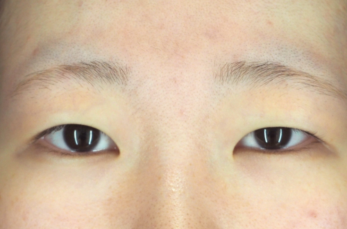二重埋没法（20代｜女性）
