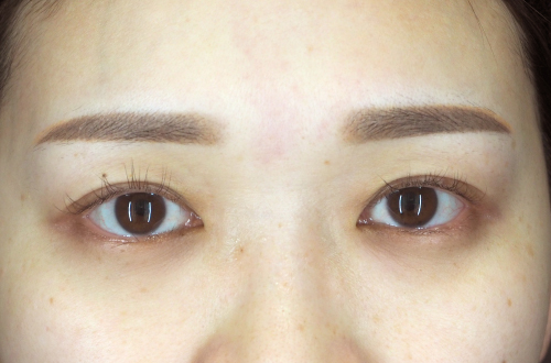 二重埋没法（30代｜女性）