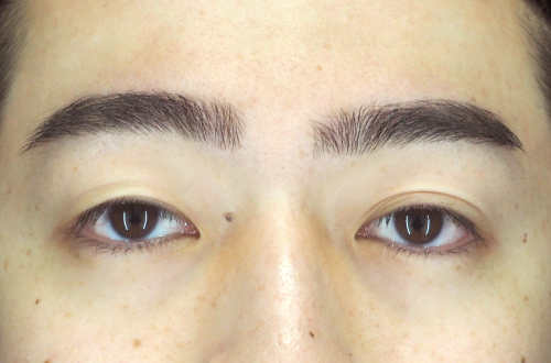 二重埋没法（20代｜男性）