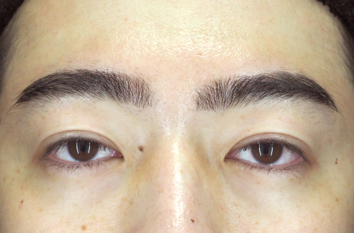二重埋没法（20代｜男性）3ヶ月後