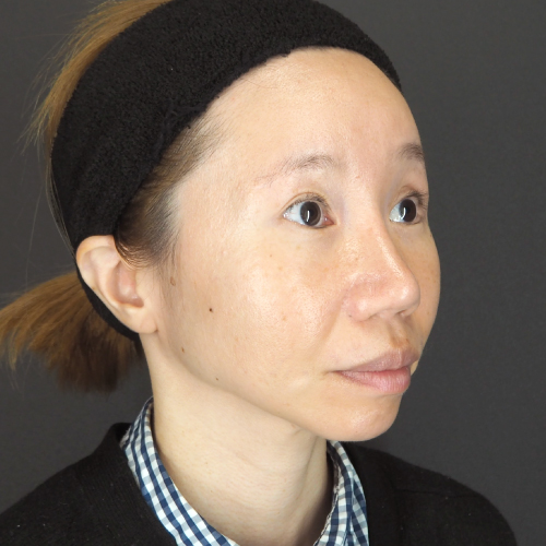 セットバック整形（30代｜女性）