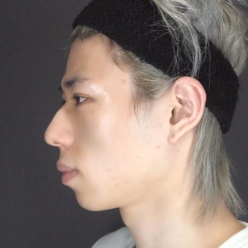 セットバック整形（20代｜男性）