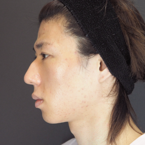 セットバック整形（20代｜男性）6ヶ月