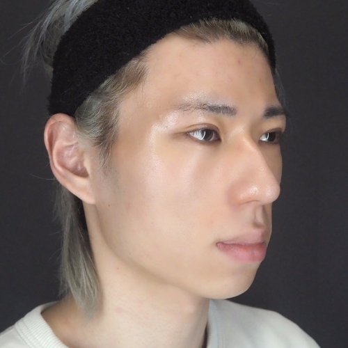 セットバック整形（20代｜男性）