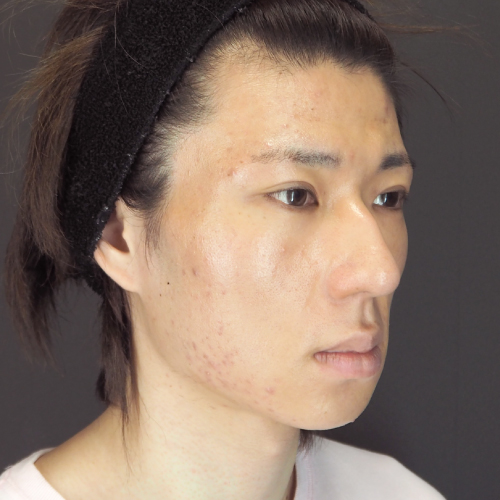 セットバック整形（20代｜男性）6ヶ月