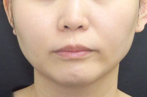 エラのボトックス注射（30代｜女性）