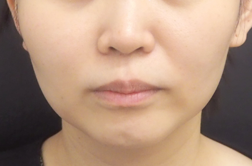 エラのボトックス注射（30代｜女性）1ヶ月後