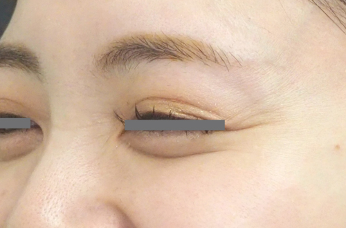 表情ジワのボトックス注射（30代｜女性）