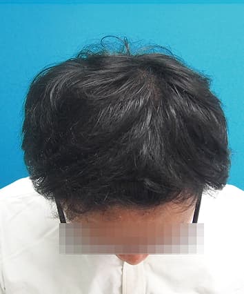 21歳男性 12ヶ月後