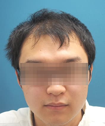 21歳男性 治療前
