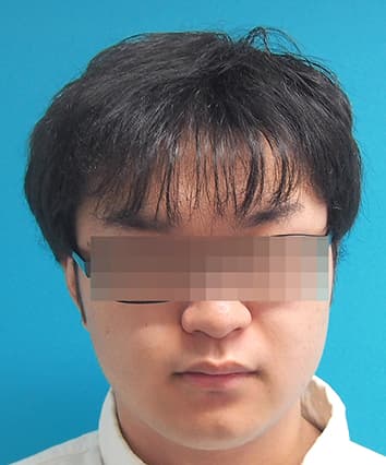 21歳男性 12ヶ月後