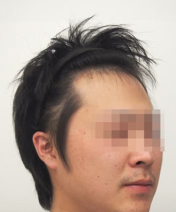 22歳男性 治療前