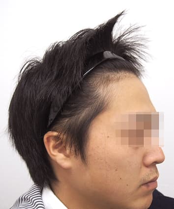 22歳男性 10ヶ月後