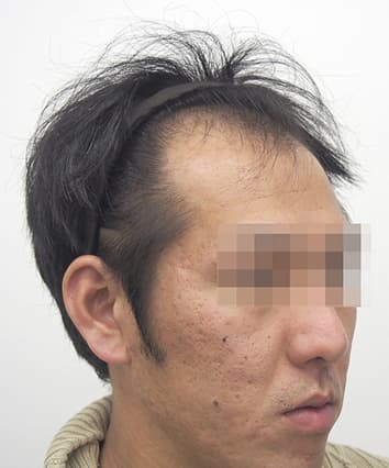 30歳男性 治療前