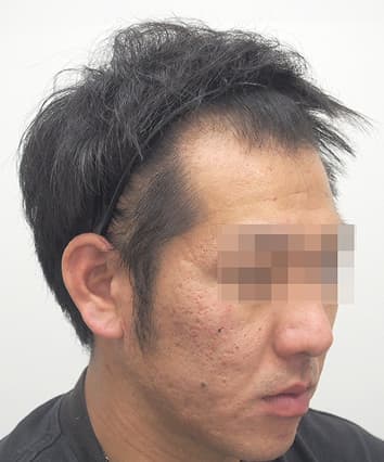 30歳男性 11ヶ月後