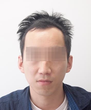 32歳男性 治療前