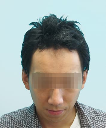 32歳男性 10ヶ月後