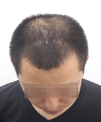 35歳男性 治療前
