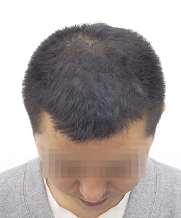 35歳男性 9ヶ月後