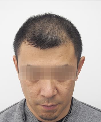 42歳男性 治療前