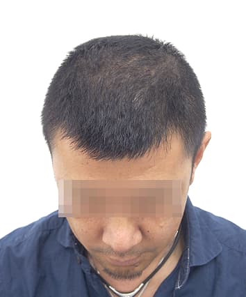 42歳男性 8ヶ月後