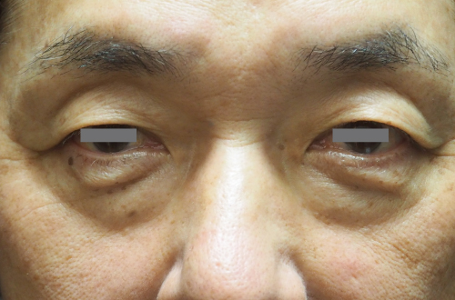 目の下のたるみ取り（50代以上｜男性）