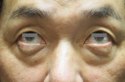 目の下のたるみ取り（50代以上｜男性）