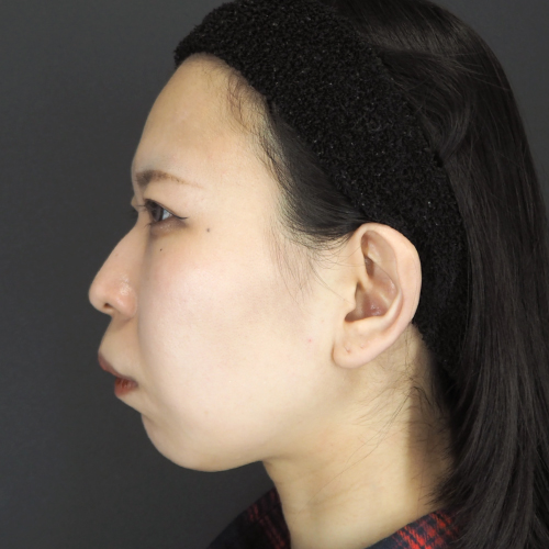 セットバック整形（20代｜女性）