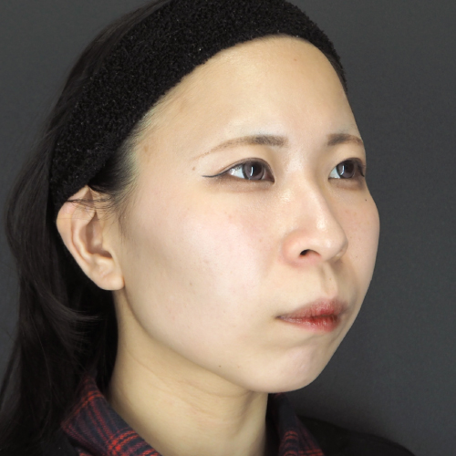 セットバック整形（20代｜女性）