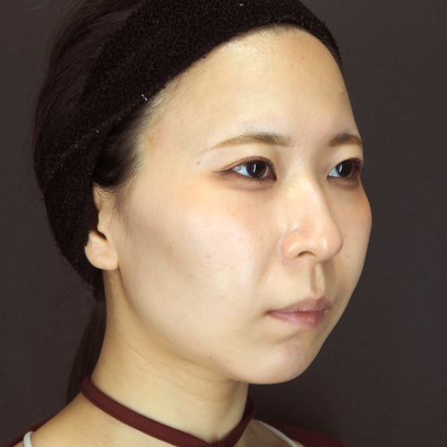 セットバック整形（20代｜女性）6ヶ月後
