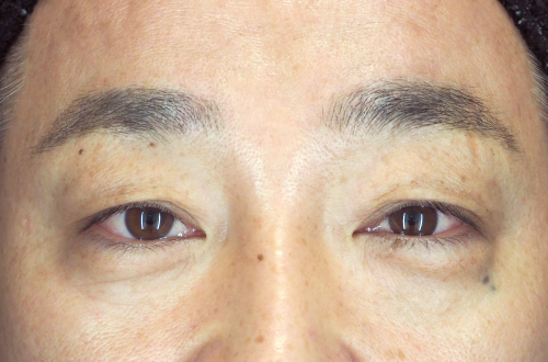 眉下切開法（40代｜男性）