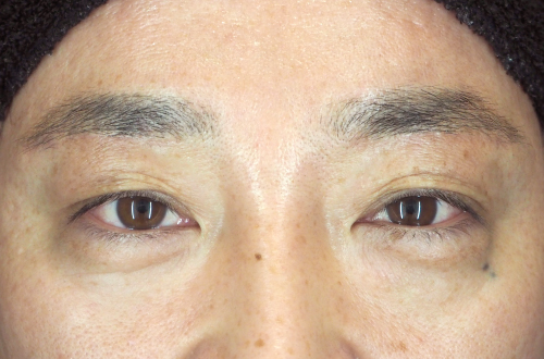 眉下切開法（40代｜男性）3ヶ月後