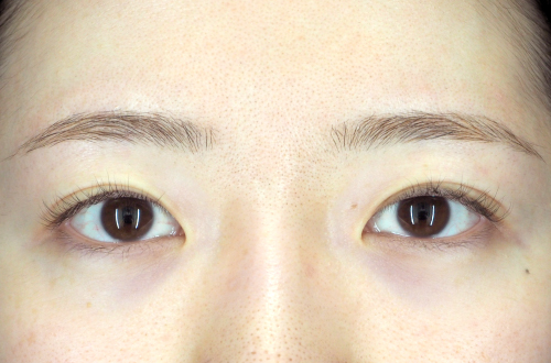 二重埋没法（20代｜女性）