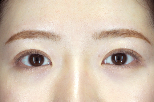 二重埋没法（20代｜女性）3ヶ月後