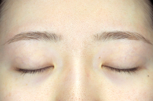 二重埋没法（20代｜女性）