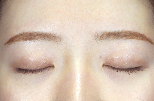 二重埋没法（20代｜女性）3ヶ月後