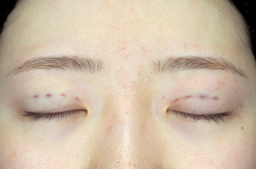 二重埋没法（20代｜女性）