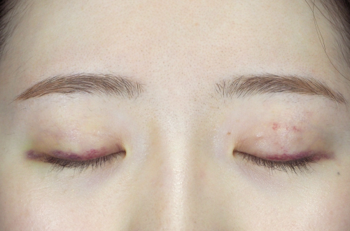 二重埋没法（20代｜女性）3ヶ月後