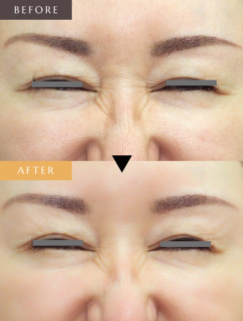 表情ジワのボトックス注射（バニーライン）