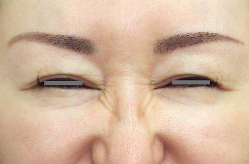 表情ジワのボトックス注射(40代|女性)