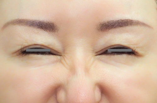 表情ジワのボトックス注射(40代|女性)2週間後