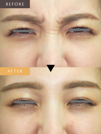 表情ジワのボトックス注射（バニーライン）