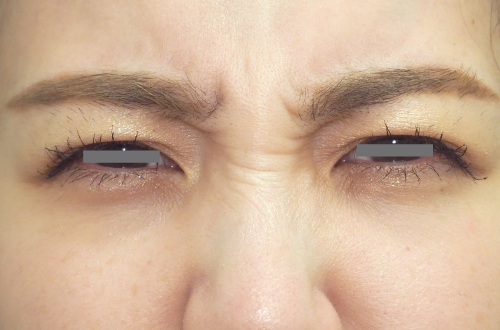 表情ジワのボトックス注射(30代|女性)