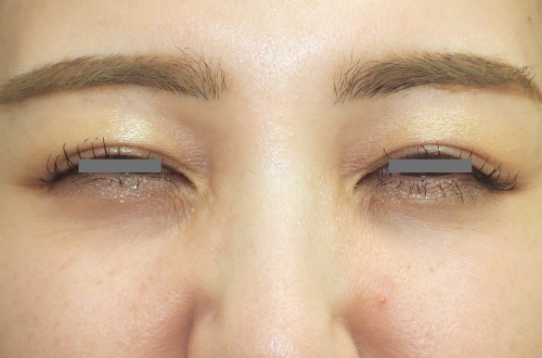 表情ジワのボトックス注射(30代|女性)2週間後