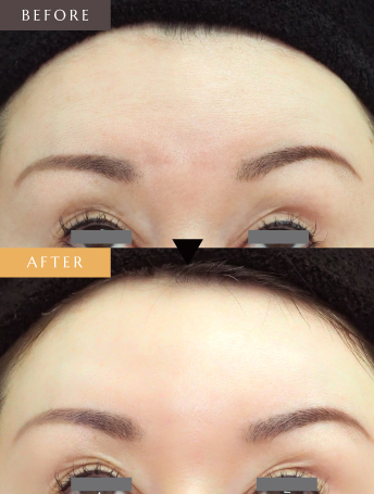 表情ジワのボトックス注射（額）