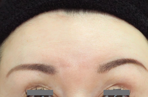 表情ジワのボトックス注射(40代|女性)